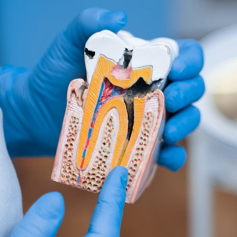 Tratamientos de endodoncia en Aluche. Clínica Dental Doctor Gonzalo