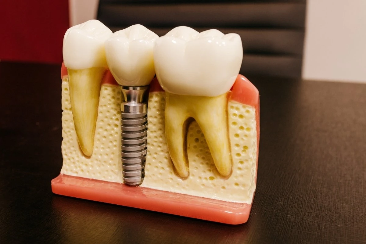 Implantes dentales en Latina-Aluche